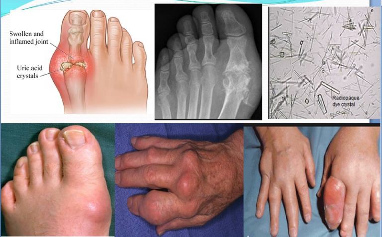 How to Prevent Chronic Gouty Arthritis Attack - Ariki Holidays