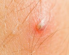 Ingrown Hair: –  What Are The Essential Aspects To Know? 