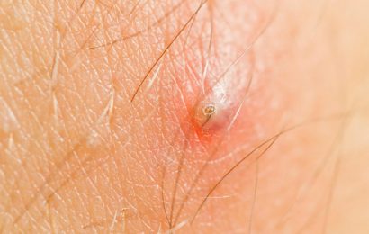 Ingrown Hair: –  What Are The Essential Aspects To Know? 